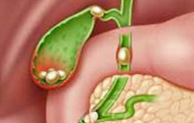 Sỏi thận thường 'đồng hành' cùng sỏi mật