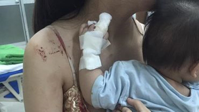 Bé Na - con chị Dung bị chuột cắn nát tay