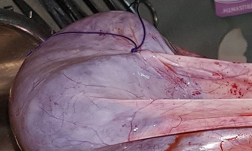 Khối u nặng hơn 6kg 