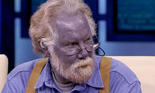 Làn da đặc biệt của một người mắc bệnh Met-H. 