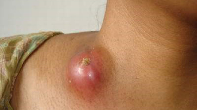 Ung thư tuyến mồ hôi hiếm nhưng cực hiểm