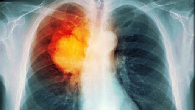 Khói thuốc lá cũng có tác động tiêu cực tới phổi và gây ra ung thư phổi. Ảnh: Medicinenet. 