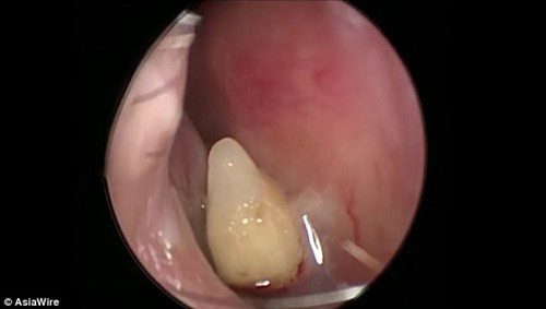 Chiếc răng mọc trong mũi bà Xia. Ảnh: Asiawire.