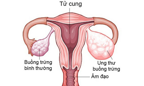 Sự khác nhau giữa buồng trứng bình thường và buồng trứng bị ung thư. Ảnh: News. 