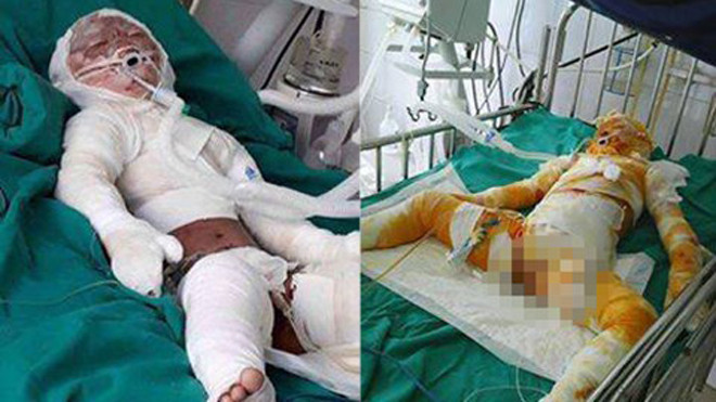 Cháu bé bị bỏng nặng toàn thân.