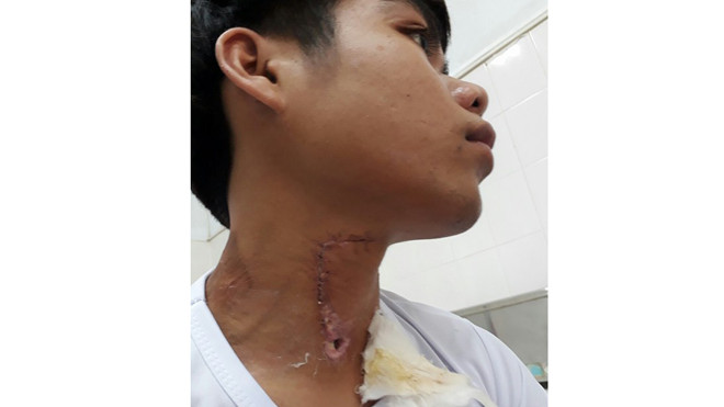 Sau khi được cấp cứu kịp thời, hiện sức khỏe anh Xanh đã ổn định và đang được chăm sóc theo dõi tại bệnh viện