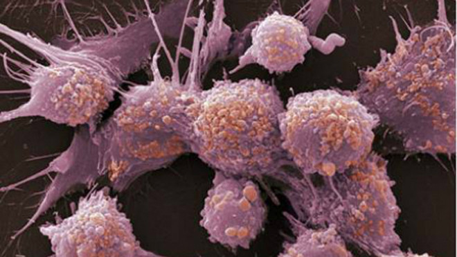 Dấu hiệu cảnh báo bạn bị ung thư tinh hoàn