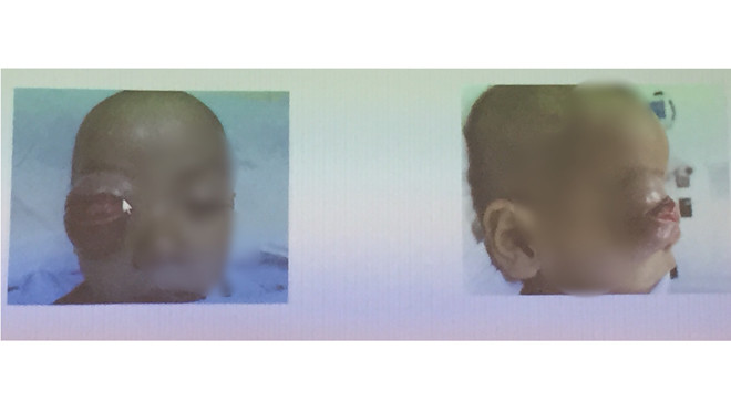 Đây được nhận định là trường hợp nặng nhất trong 10 năm vừa qua tại BV Tai Mũi Họng