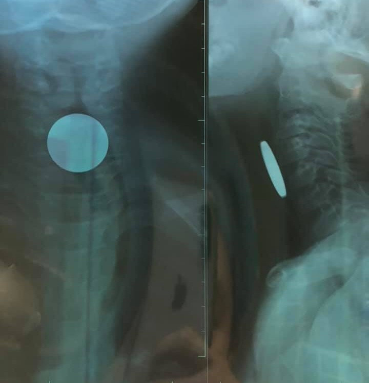 Quảng Bình: Phát hiện đồng xu nằm trong thực quản bé trai 5 tuổi