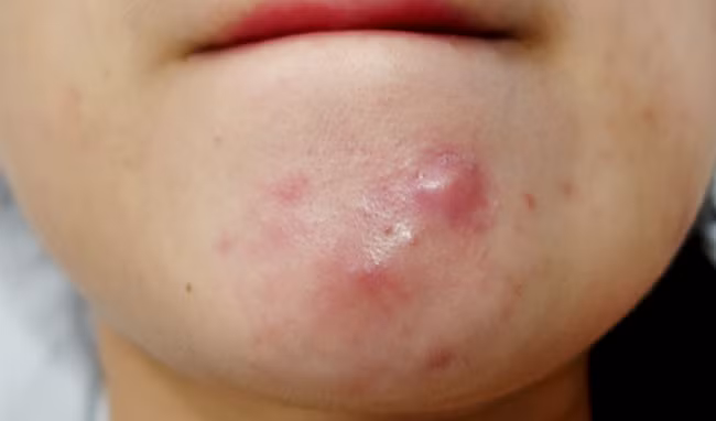 Mụn trứng cá dạng nang rất khó điều trị