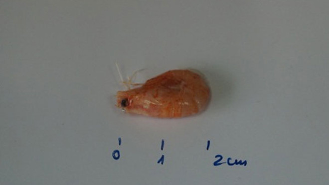 Con tôm được lấy ra từ đường thở bệnh nhân. Ảnh: BS cung cấp