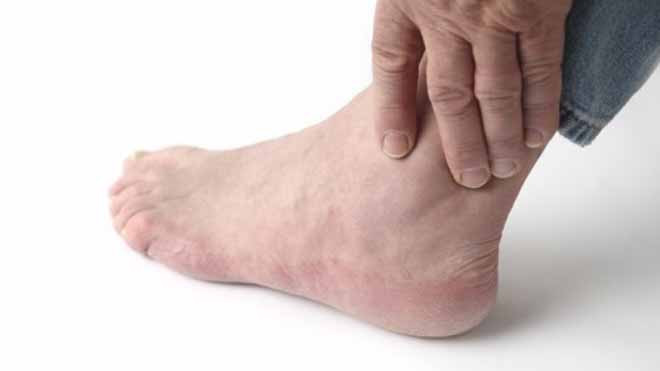 Những thực phẩm người bệnh gout tuyệt đối không ăn
