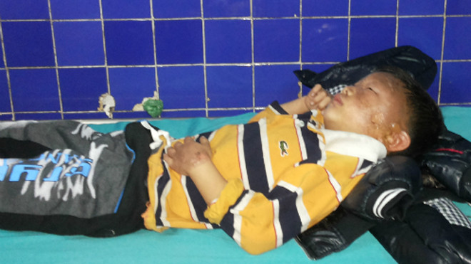 Bé trai bị bỏng mặt do mẹ dùng xăng mồi lửa. Ảnh: Long Nhật.