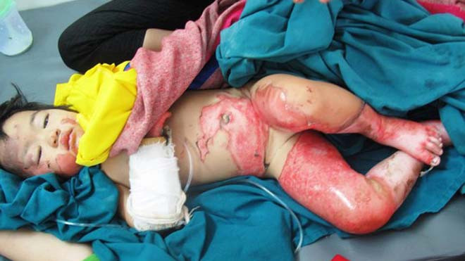 Bé D. bị bỏng nặng hơn 50% diện tích cơ thể