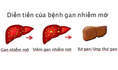 Bệnh gan nhiễm mỡ gây viêm gan nhiễm mỡ, xơ gan và ung thư.