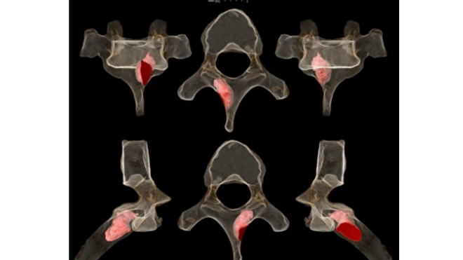 Mẩu xương sống cổ đại 2 triệu tuổi bị ung thư (phần màu hồng). Ảnh: sajs.co.za.