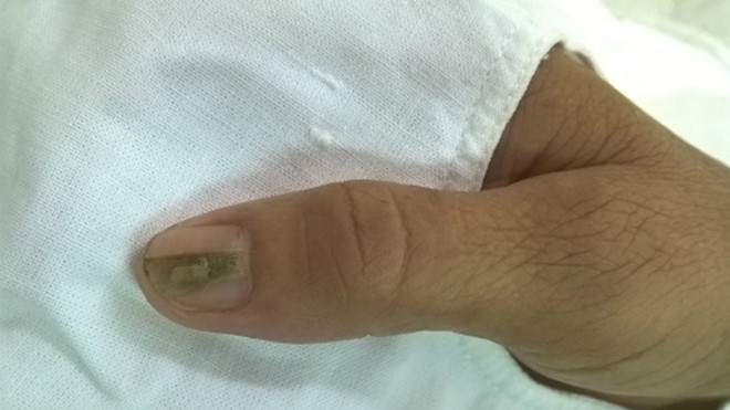 Biểu hiện của u cuộn mạch dưới móng là móng tay có sọc, đau nhức kéo dài. Ảnh: X.A 