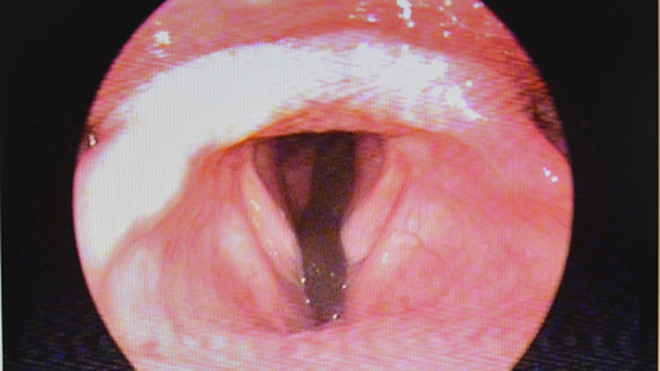 Hình ảnh nội soi phát hiện con đỉa. Ảnh: Hoàng Yến (Bệnh viện Đa khoa).