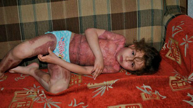 Sofia Ezhova bỏng nặng sau khi làm theo lời hướng dẫn "trở thành nàng tiên" của trò chơi trên mạng - Ảnh: The Sun