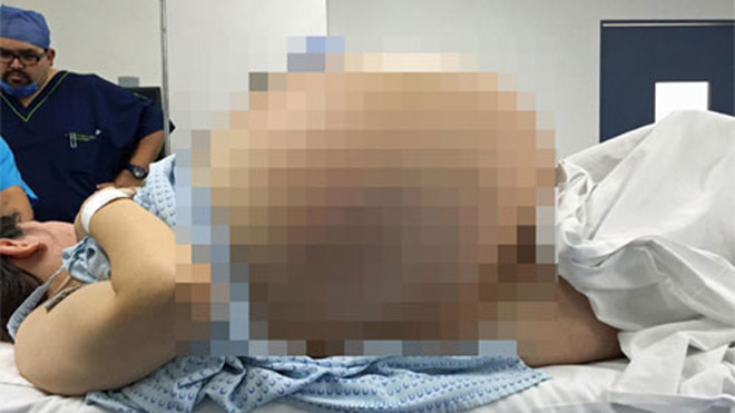 Khối u từng khiến cô gái gặp khó khăn trong vận động, đi lại. Ảnh: Caters