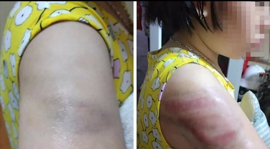 Gia đình cháu bé chia sẻ hình ảnh cháu bị cô giáo đánh tím vai - Ảnh: Hoàng Long