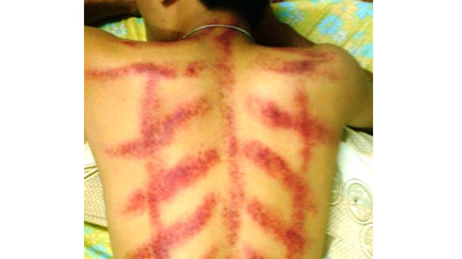 Các chuyên gia khuyến cáo, không nên lạm dụng việc cạo gió để chữa cảm lạnh vì có thể gây nên tai biến. Đặc biệt, tuyệt đối không được cạo gió cho bà bầu và trẻ em