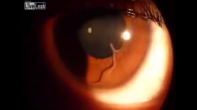 Con giun màu trắng phát hiện trong mắt bệnh nhân.