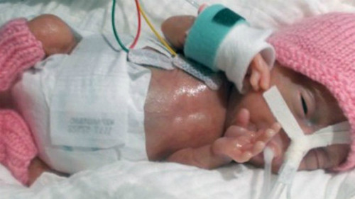 Emilia lúc mới sinh. Ảnh: CEN.