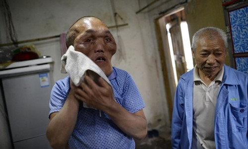 Hạ Nguyên Hải với khuôn mặt biến dạng khiến ông trông giống người ngoài hành tinh. Ảnh: Sun.