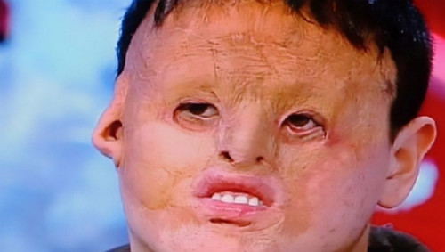 Dilmrod trước khi phẫu thuật. Ảnh: CEN.