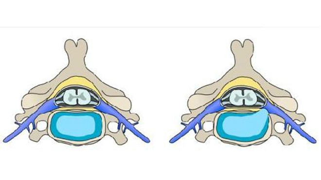 Ảnh bên phải cho thấy nhân nhầy thoát ra tạo thành khối thoát vị chèn ép vào rễ thần kinh gây ra bệnh. 