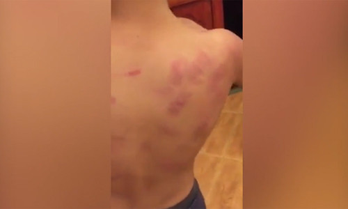 Phụ huynh tố cô giáo mầm non đánh con trai bầm tím lưng