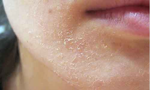 Lột trắng da làm đẹp không đúng cách coi chừng gây hại cho da.