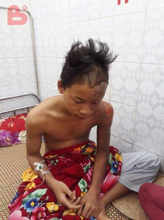 Thiếu niên 15 tuổi bị sét đánh cháy xém nửa người