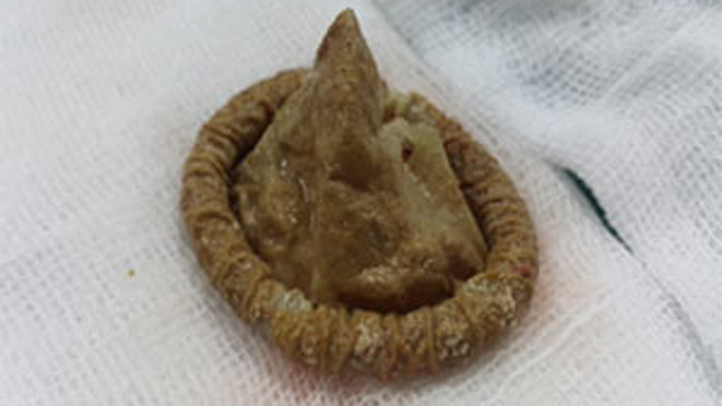 Bao cao su được lấy ra từ bàng quang của bệnh nhân.