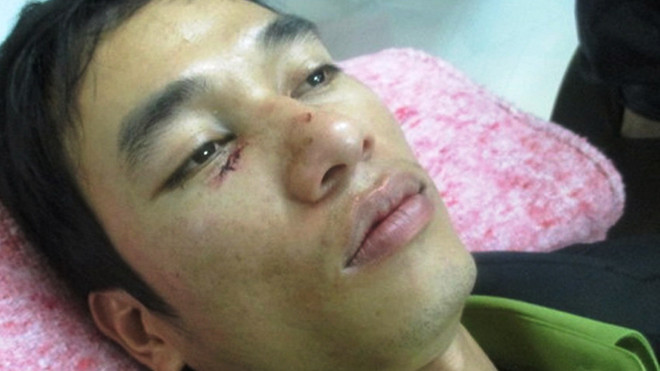 Kiểm lâm viên Lê Anh Tuấn bị lâm tặc tấn công phải nhập viện cấp cứu. Ảnh do kiểm lâm cung cấp