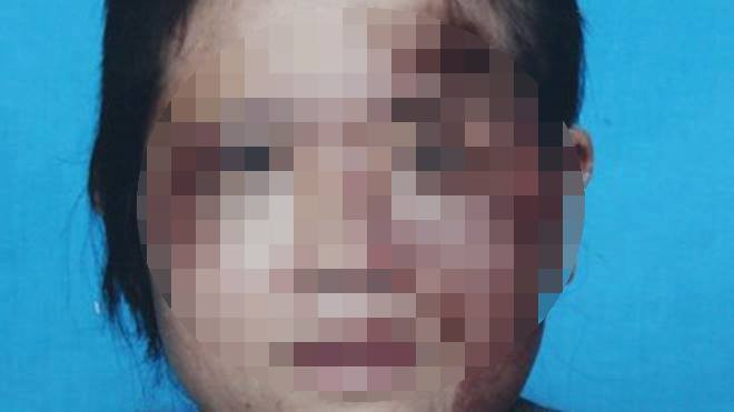 Chị H. với khuôn mặt biến dạng