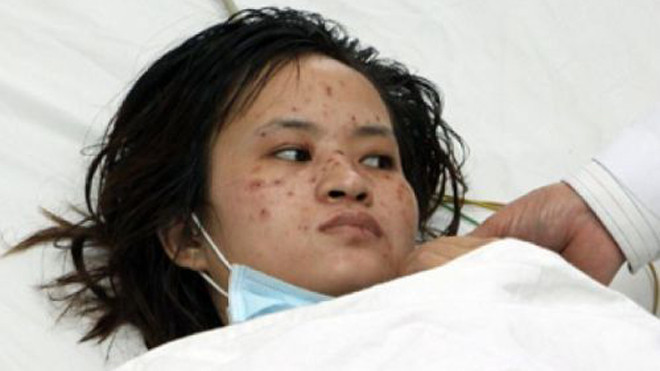 Bệnh viêm não mô cầu khó phát hiện sớm, các nốt tử ban, co giật hoặc mê sảng, nôn ói xuất hiện ở giai đoạn nặng. Ảnh: PNVN.