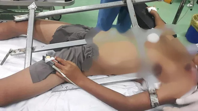 Em Tr.A.D. được đưa tới bệnh viện cấp cứu trong tình trạng bị thanh sắt đâm thấu ngực - Ảnh: Bệnh viện cung cấp