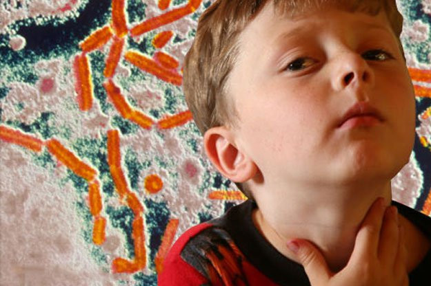 Bệnh viêm đường hô hấp trên ở trẻ nhỏ