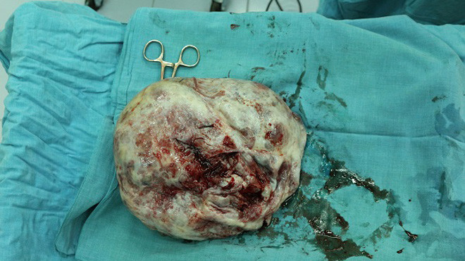 Kinh hãi với khối u nặng 4kg trong buồng trứng bệnh nhân