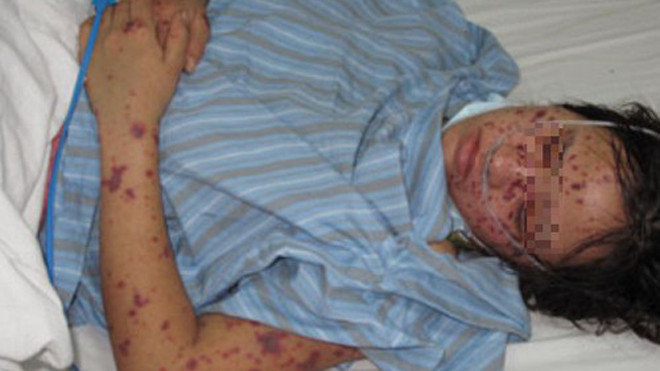 Biểu hiện ban đầu của viêm não mô cầu có thể giống như viêm họng thông thường tuy nhiên diễn tiến xấu rất nhanh. Ảnh: Bác sĩ cung cấp.