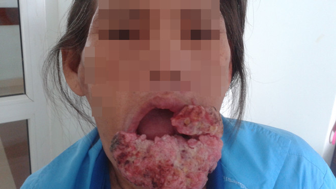 Khối u môi dưới sùi to, lở loét lan rộng trên mặt bệnh nhân