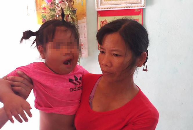 Cháu N.T.H.Y bị méo miệng đang được điều trị