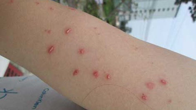 Rát bỏng, da phồng rộp thành từng nốt nổi mụn nước, lở loét là những gì bạn Trần Thị Thắm phải chịu đựng khi tiếp xúc với kiến ba khoang. Ảnh: L.TUYẾT