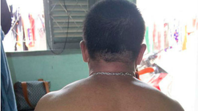 Anh T. bị các đối tượng đánh gây thương tích nhiều chỗ ở đầu và lưng