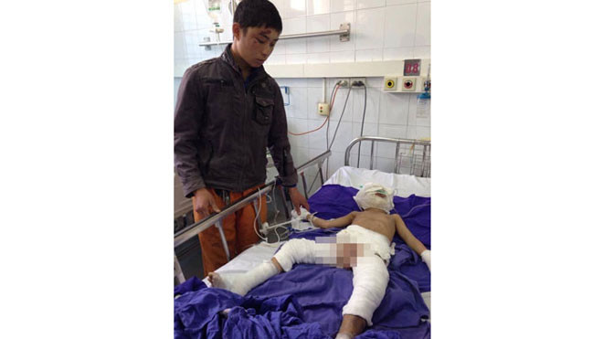 Bé Cường bị bỏng nặng nhất là vùng mặt, cổ, hai bên đùi và cơ quan sinh dục. Ảnh: VnExpress