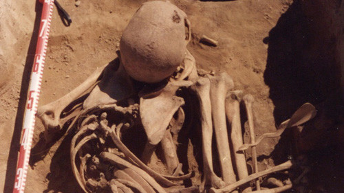 Bộ xương được phát hiện ở vùng Siberia, Nga, với các bằng chứng ung thư di căn. Ảnh: Canadian Press