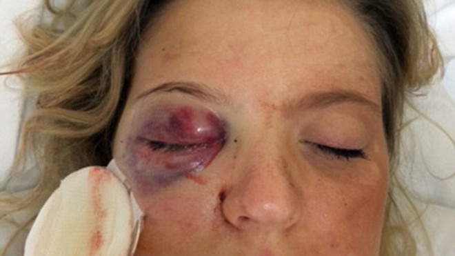 Robinson bị nện vỡ mắt phải.