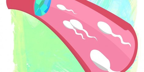 Vasalgel giống như một bộ lọc chèn trong ống dẫn tinh, có thể cản trở sự di chuyển của tinh trùng. Ảnh: mcgilldaily 